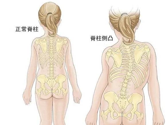 青少年睡姿不对，真能把脊柱睡“弯”吗？