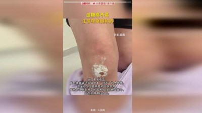 看腿就能判断血糖高不高？专家：皮肤变化成因复杂，不能一概而论